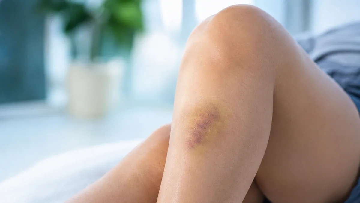 Genou avec un hématome violacé et jaunâtre, photographié en lumière naturelle douce